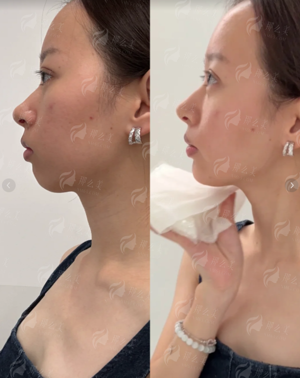 <strong>郝斌主事眼鼻整形技术分析：优势细节全解析</strong>