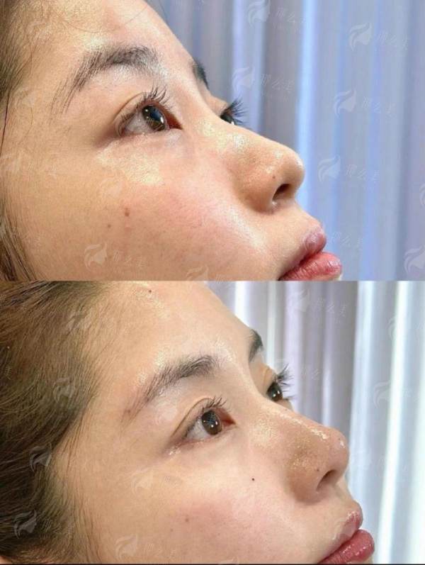  第一次祛眼袋如何不踩雷？认准哈尔滨瑞丽张川医生，新颜智尚小程序一键预约，详解手术流程与术后护理，安心变美！