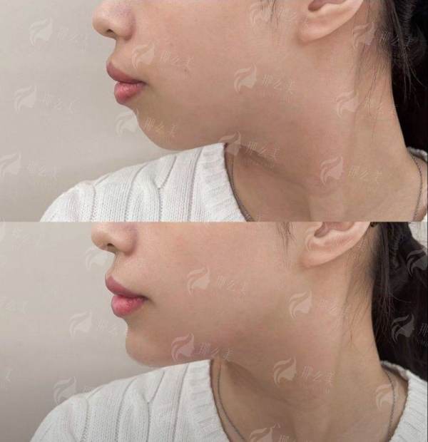 <strong>深入解析：钻石三角鼻雕技术优势有哪些？</strong>