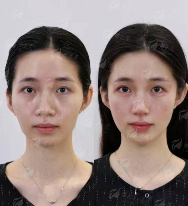 <strong>成都华生铂悦整形王欣大腿吸脂真实口碑实例分享</strong>