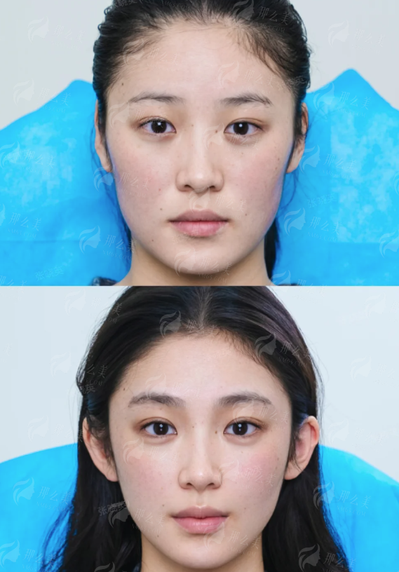 三、东莞美立方伊肤泉微针祛痘价格表