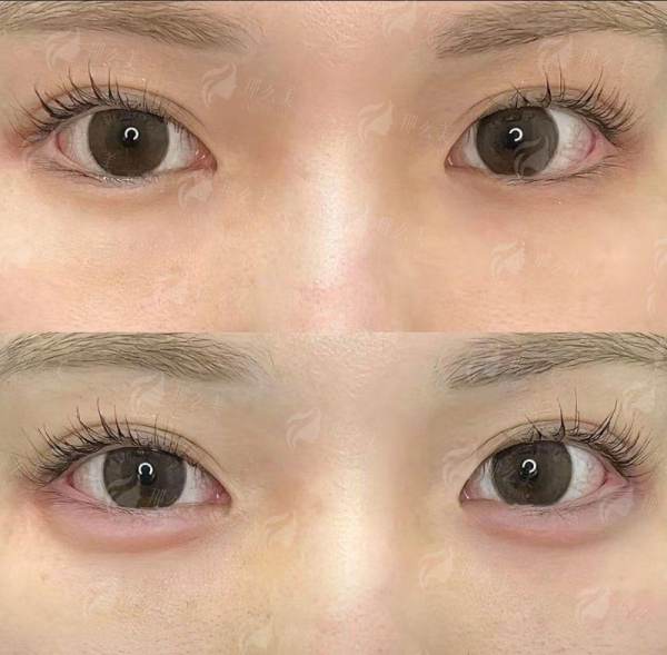 <strong style="color: rgb(255, 0, 0);">武汉紫荆医院隆鼻项目特色与仪器支持</strong>