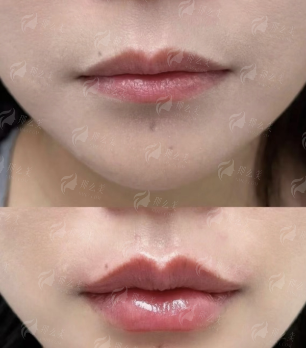 <strong>精灵耳做不好真的特别假！选择泉州亿星医疗美容的终极理由</strong>