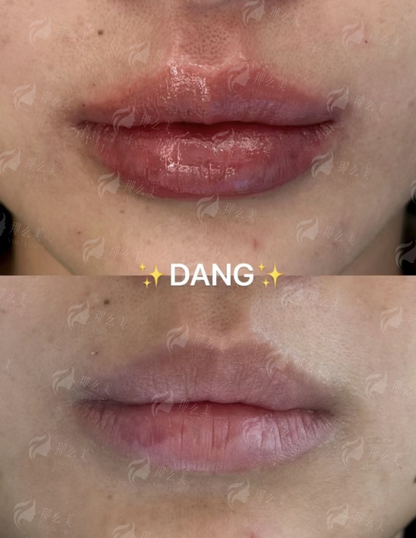 二、东莞美立方蜂巢皮秒四大特色项目