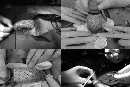 <strong>精细化雕刻紧致小V脸的核心：刘侍浩院长的出色技术解析</strong>