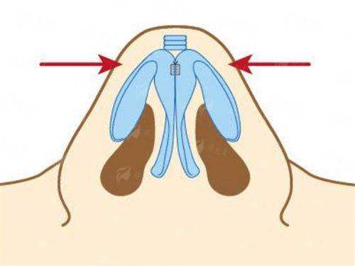 <strong>在华美做紧致小V脸，价格贵吗？收费标准是怎样的？</strong>