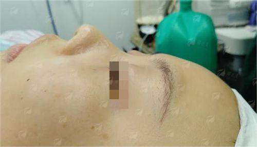 <strong>特色仪器助力：科技如何让眼修复更精细、更安心？</strong>