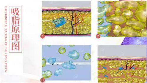 想约厦门趣净肤怕踩坑？新手必看防坑攻略+正确预约路径解析，名额有限速抢，新颜智尚小程序一键预约