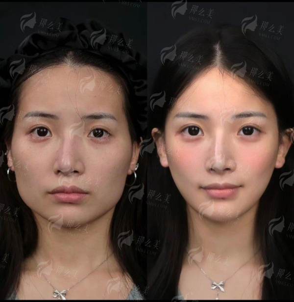 四、珠海雅媛隆胸价格透明化：项目明细与增值服务