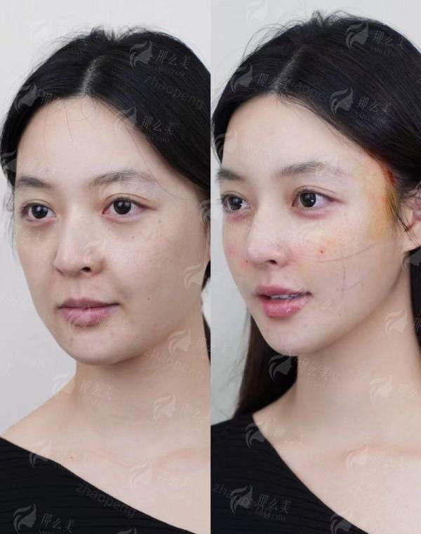 <strong>患者口碑与真实实例：看他们如何成功甩掉下颌赘肉</strong>