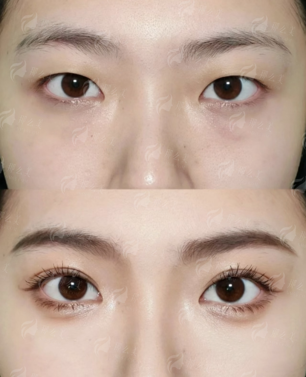 <strong>揭秘脂肪丰臀+腰臀雕塑：如何一站式打造自然蜜桃臀？</strong>