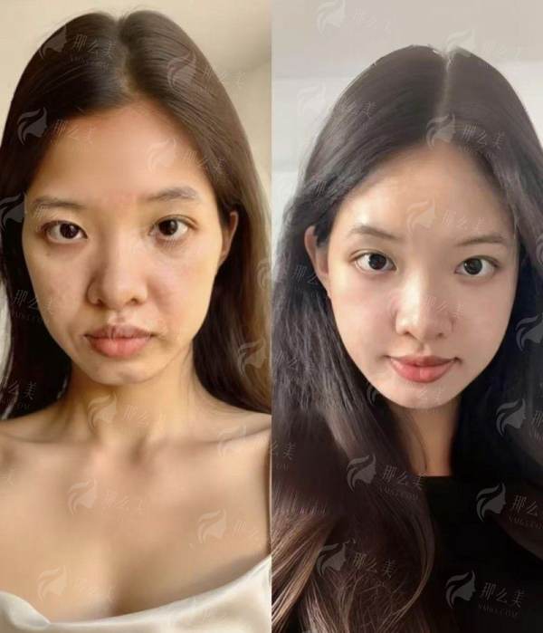 <strong>郑州她山医疗李永峰丰胸术后修复过程全解析</strong>