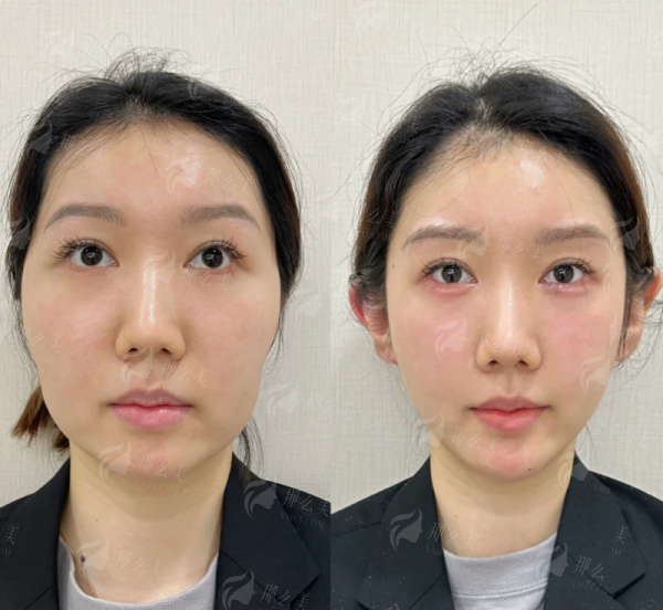 三、珠海雅媛隆胸真实实例：术前术后对比与成效反馈