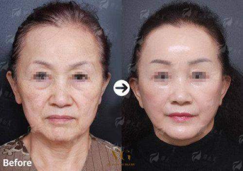 大连做双眼皮好的医生刘志刚：个性化定制的综合眼整形骨干医生