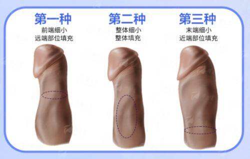 <strong>三、如何预约广州东莞紫芯的袁道红院长做隆鼻面诊？</strong>