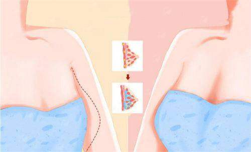 <strong>三、<strong>长沙祺美胸整形的乳房不对称矫正价格贵吗？与国有医院相比如何？</strong></strong>