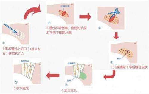 二、赵敬国隆胸手术方案对比分析