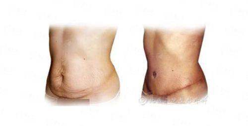 <strong>三、在邵阳曹家整形医疗美容做陈坚医生双眼皮，成效和审美如何？</strong>