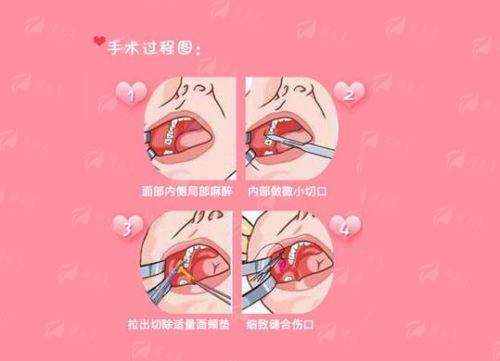 陈坚医生双眼皮手术口碑如何？邵阳曹家整形真实反馈一览，新颜智尚小程序预约