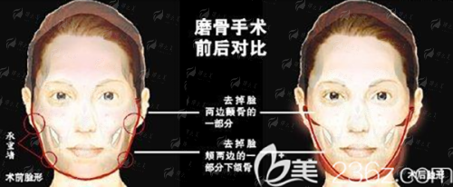 <strong>四、如何预约北京嘉禾的双眼皮面诊及术后要注意什么？</strong>