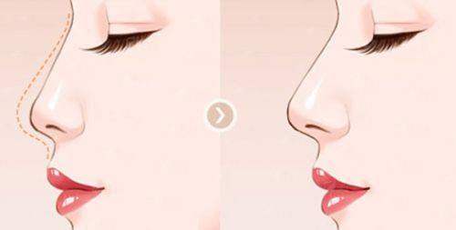 <strong>四、<strong>如何预约重庆军美谭焰红院长的自体软骨隆鼻面诊？</strong></strong>