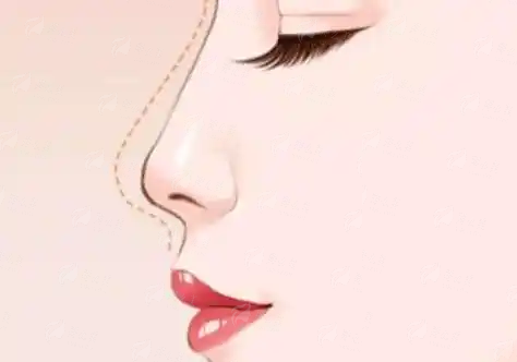 <strong>四、找袁道红院长做隆鼻前，你还需要知道这些事</strong>