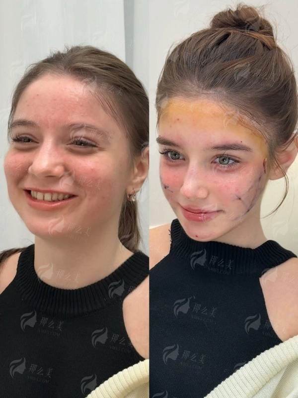 <strong>二、<strong>柳州美丽焦点的吸脂手术有没有后遗症？</strong></strong>