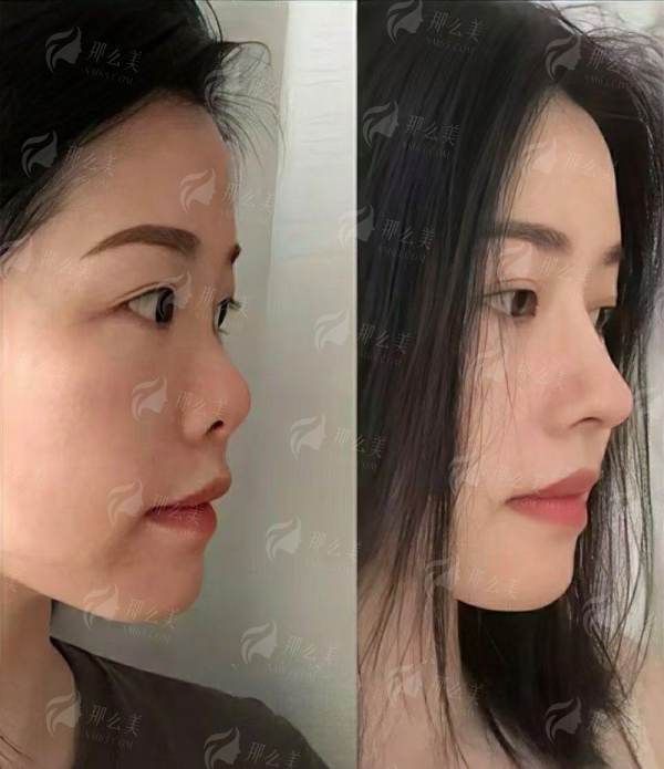 深度审美解析：王香平与刘志刚的双眼皮风格有何不同？