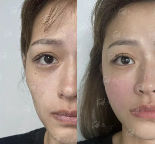 <strong>二、<strong>在重庆军美做谭焰红自体软骨隆鼻，流程和价格是怎样的？</strong></strong>