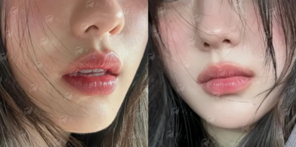 <strong>二、上海首尔丽格唐鏖医生的人中缩短，价格和方案如何？</strong>