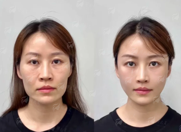 <strong>三、上海仁爱医院做双眼皮的价格与流程是怎样的？</strong>