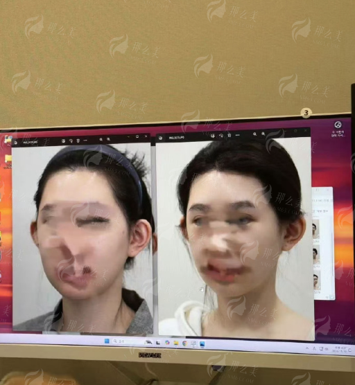 <strong>四、在上海仁爱医院做双眼皮，术后要注意什么？</strong>