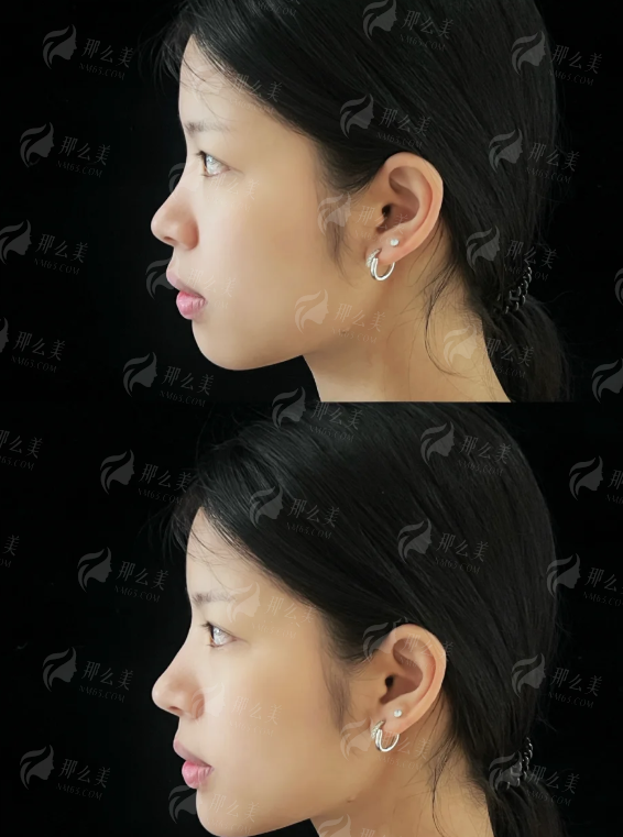 <strong>二、在重庆华美做隆胸，价格贵不贵？</strong>