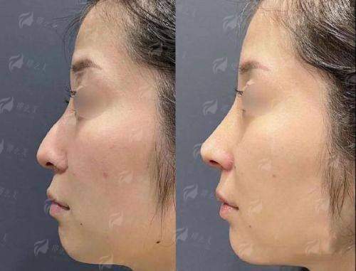 <strong style="color: rgb(255, 0, 0);">四、深圳艺星牛克辉隆鼻价格解析：2026年收费标准与项目区间</strong>