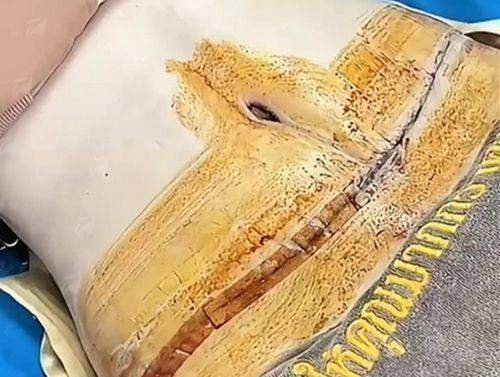 <strong>侯典举医生技术解析：精细解剖下的艺术提升</strong>