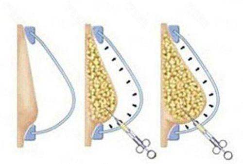 <strong>南京美莱丰胸价格区间与收费标准透明解读（2026年参考）</strong>