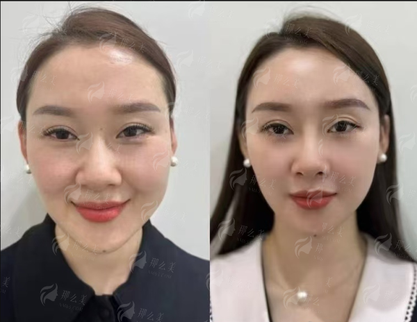 <strong style="color: rgb(255, 0, 0);">二、揭秘“半软糖鼻”专项技术：自然挺翘背后的硬核科技支撑</strong>