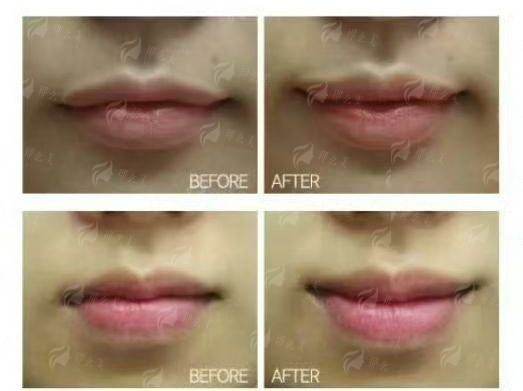 <strong>PEEK颌面整形价格明细如何？2026年市场区间参考</strong>