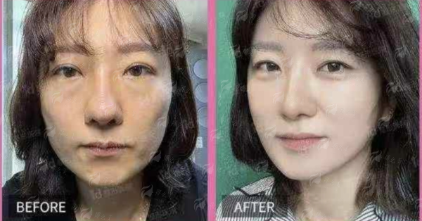 <strong>2026年成都八大处面部年轻化大小拉皮价格表参考</strong>