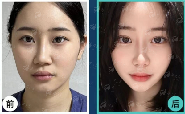 <strong>李高静医生技术好在哪里？细数其祛眼袋技术的四大优势</strong>