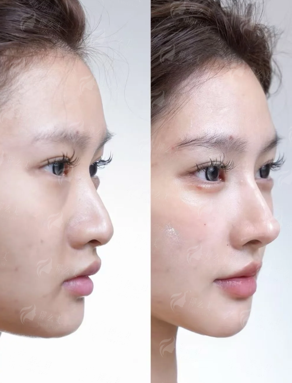 <strong style="color: rgb(255, 0, 0);">五、真实实例分享：看牛克辉院长如何实现“自然挺翘”的蜕变</strong>