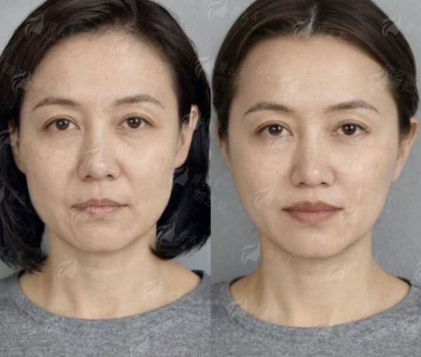 <strong>总结：为什么选择北京丰联丽格进行眼修复？</strong>