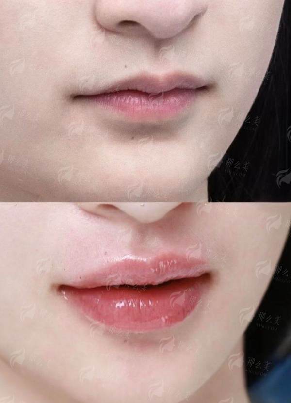 <strong>广州祈福医院的特色：为何是PEEK颌面整形的优选平台？</strong>