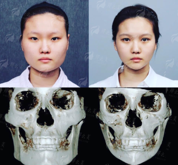 湖州曙光祛眼袋多少钱？李高静医生案例风格与医院地址一览，新颜智尚小程序一键预约！