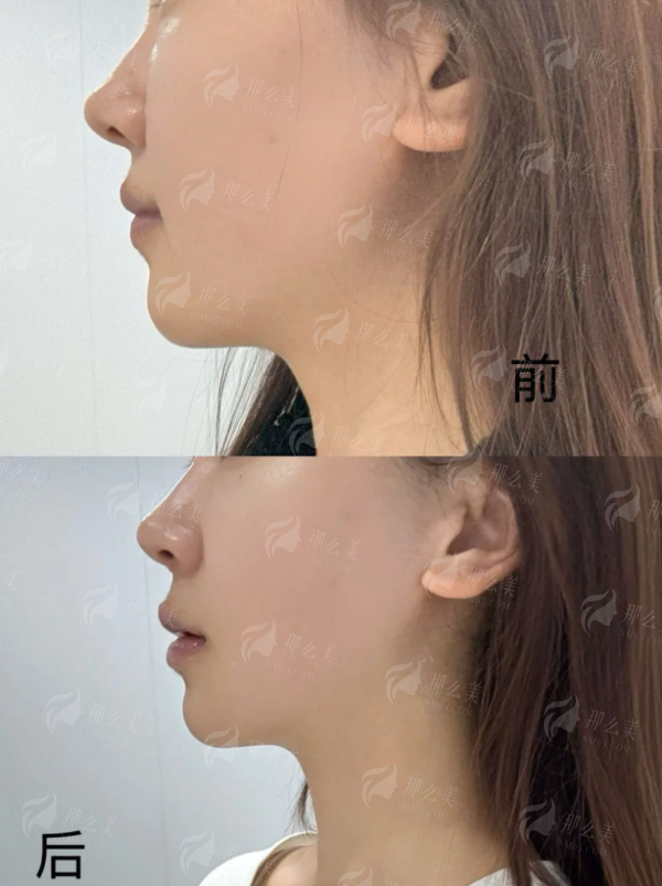 <strong>郑州壹加壹线提升价格贵吗？2026年收费标准参考</strong>