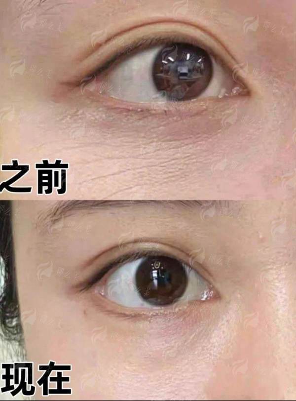 <strong>梁赞姜医生在下颌角磨骨与颧骨内推降低方面有何独到之处？</strong>