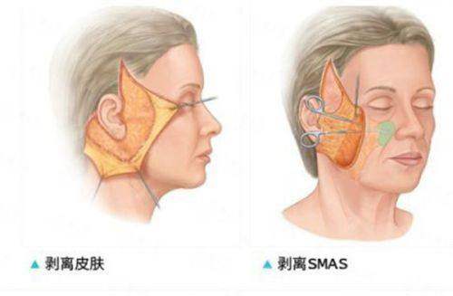 黄学峰医生富贵包分型收费明细，中包29，800元起，新颜智尚小程序预约看真实案例