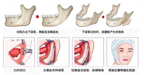 长沙雅美全切双眼皮价格多少？附新颜智尚小程序预约方式