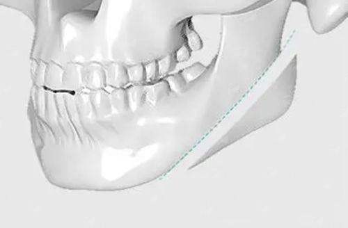 <strong>三、<strong>在长沙星雅找罗盛军做鼻综合，价格和流程是怎样的？</strong></strong>