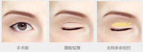 <strong>三、长沙雅美全切双眼皮的价格与医生怎么选？</strong>